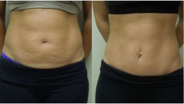 What is Tummy Tuck surgery