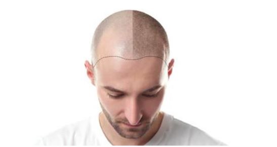 You are currently viewing Dr. Manas S.N. Answers the Question: Is Shedding After Hair Transplant Normal?